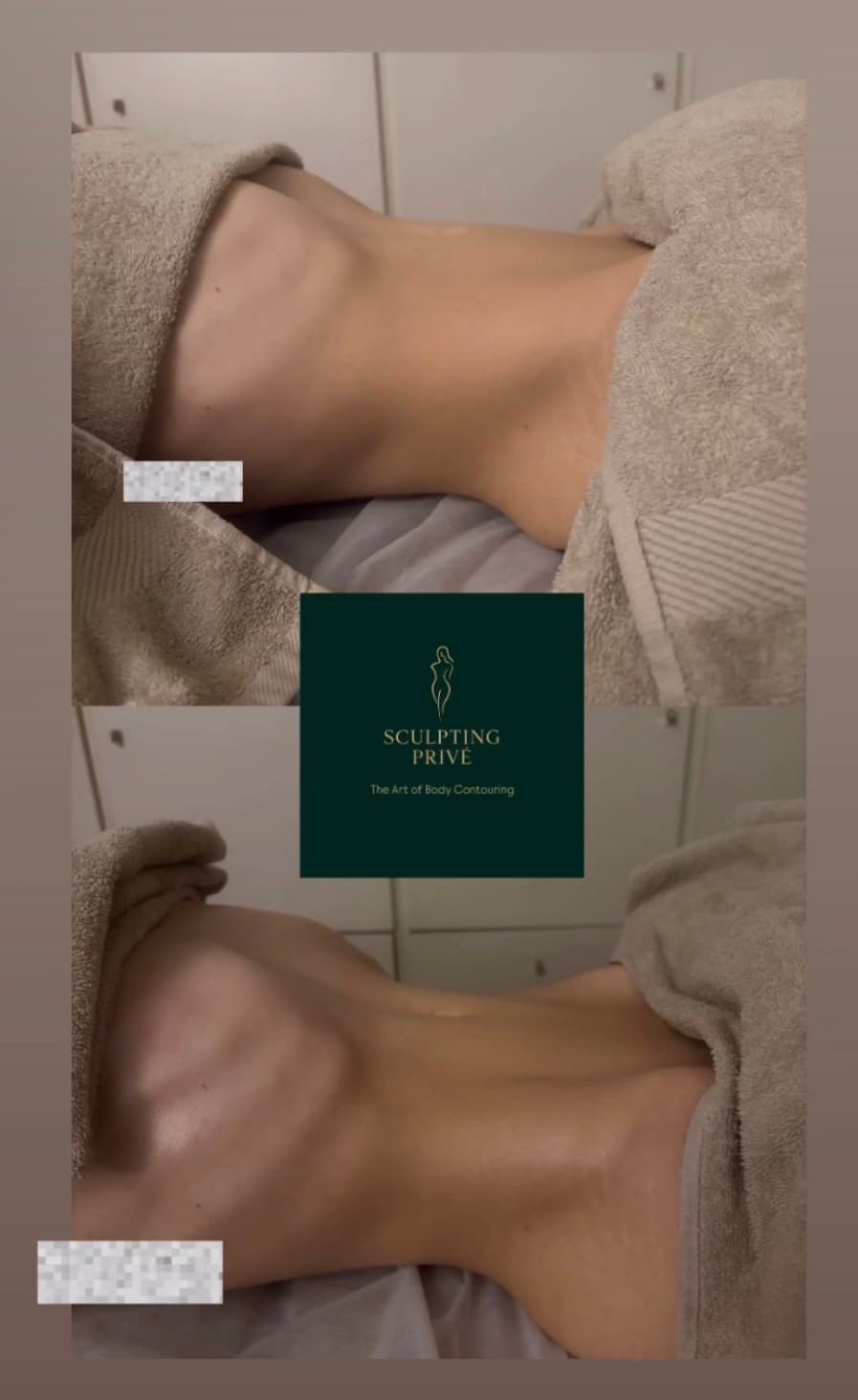 Ergebnis einer brasilianischen Lymphdrainage, Beispiel 2